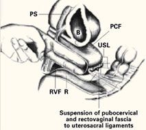 Ischial Spine