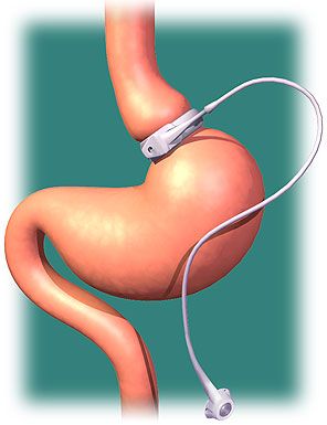 Lapband