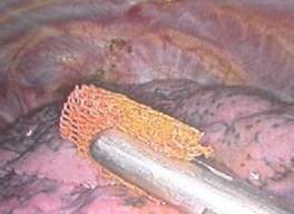 Role of video assisted thoracoscopy