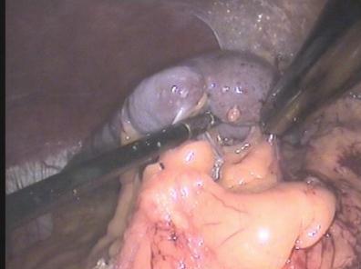 Splenectomy