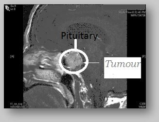 Pituitary Tumour