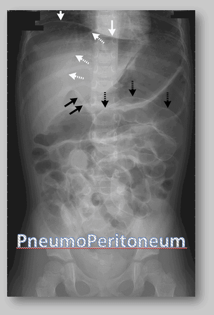 Efeect of Pneumoperitoneum on Laparoscopic Surgery