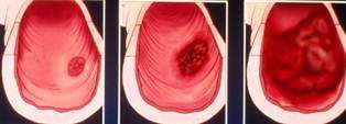 Polyp Colon