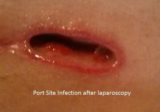 Port Site Infection after Laparoscopy