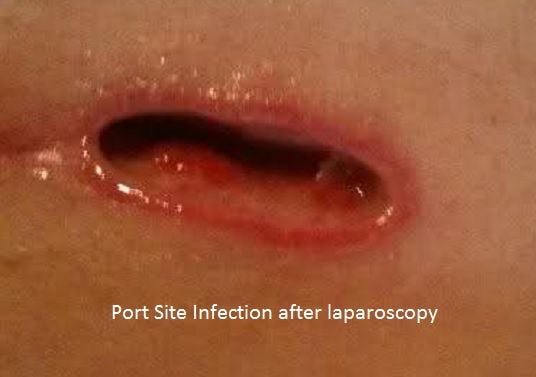 incision infection #11