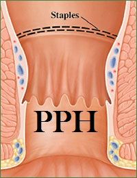 Stapled Hemorrhoidopexy