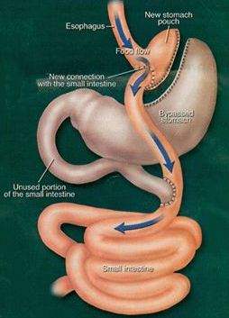 Roux En Y Gastric Bypass