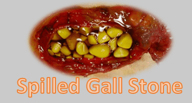 Spilled Gall Stone