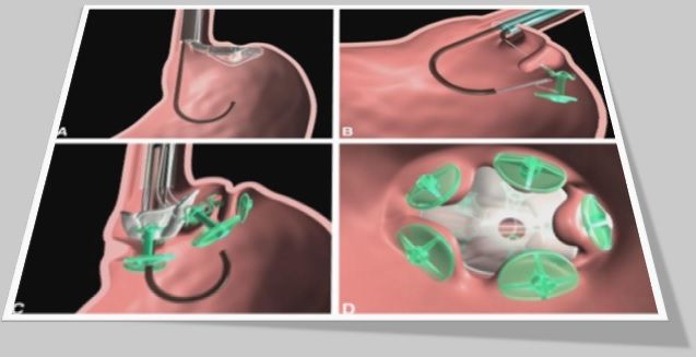 Transesophageal Endoscopic Plication