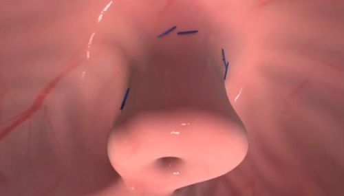Trans Oral Incisionless Fundoplication