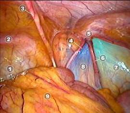 Laparoscopic Anatomy of Inguinal Hernia