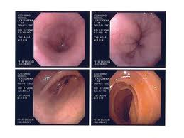Upper GI Endoscopy