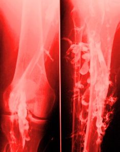 Venous thrombosis