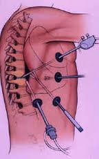 Video Assisted Thoracic Surgery