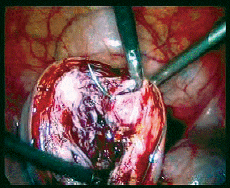 Suturing the cut edges after myomectomy