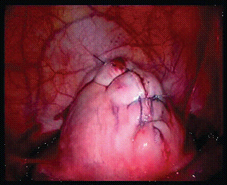 After closure of myometrium.