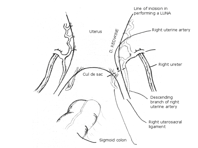 Line of incision for Laparoscopic Uterosacral Nerve Abalation [LUNA]