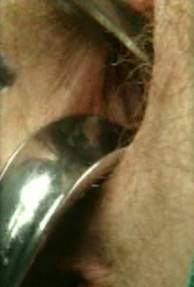 faq laparoscopic hysterectomy clip