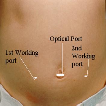 faq laparoscopic hysterectomy clip