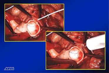 glues and adhesive in tissue approximation clip