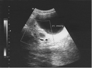 Pelvic ultrasonography showing a normal-sized ovary with follicular growth and blood flow in the vessels.