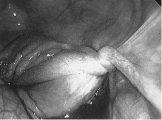 Laparoscopic aspect of the twisted right ovary.