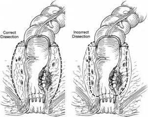 Schematic representation of the correct TME dissection versus an incorrect dissection