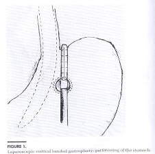 laparoscopic surgery in pregnancy precautions and complications