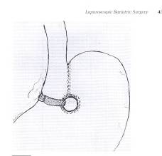 laparoscopic surgery in pregnancy precautions and complications