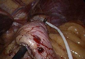 laparoscopic surgery in pregnancy precautions and complications