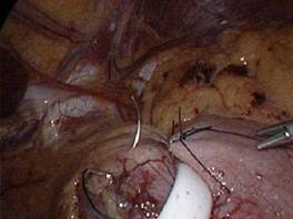 laparoscopic surgery in pregnancy precautions and complications
