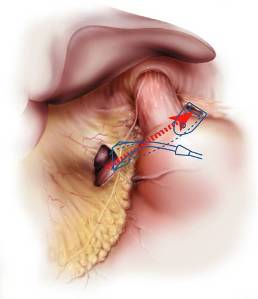 laparoscopic surgery in pregnancy precautions and complications