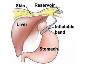 laparoscopic surgery in pregnancy precautions and complications