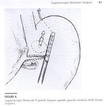 laparoscopic surgery in pregnancy precautions and complications
