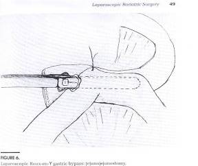 laparoscopic surgery in pregnancy precautions and complications