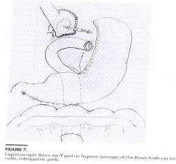 laparoscopic surgery in pregnancy precautions and complications