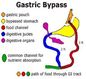gastric_by-pass