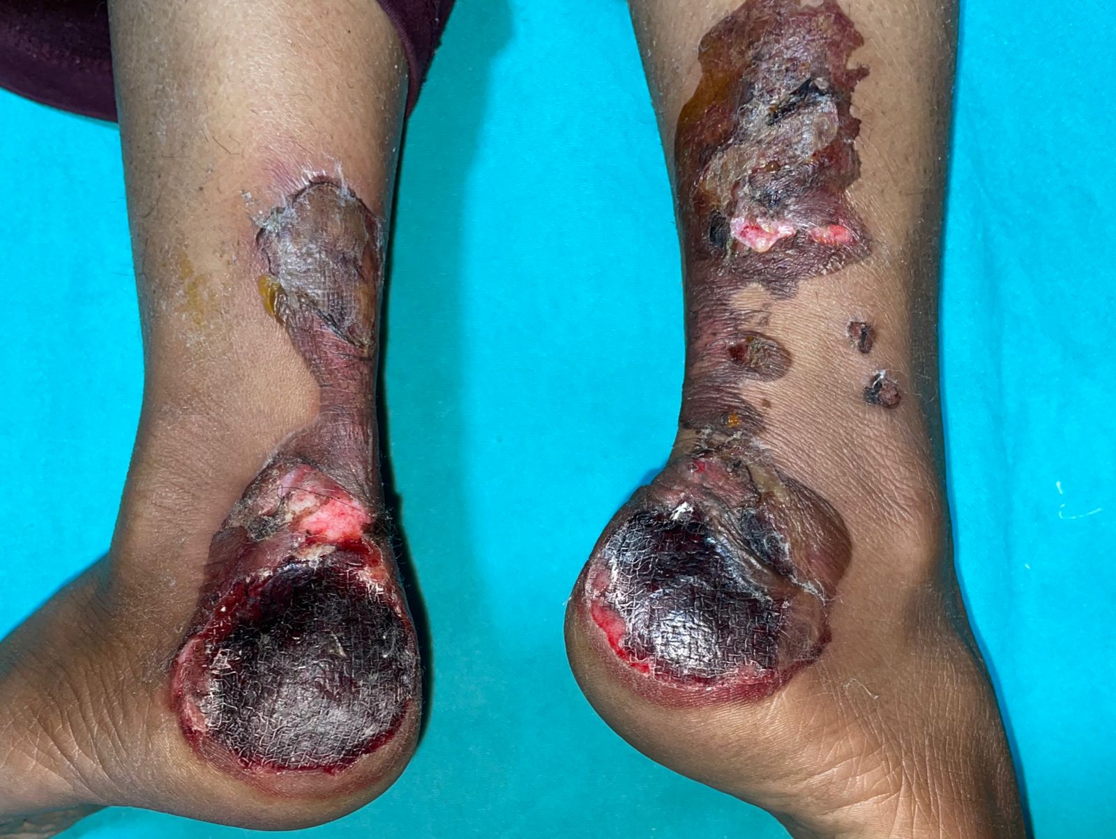 Electric Burn Injury due to wrong placement of Patient return plate