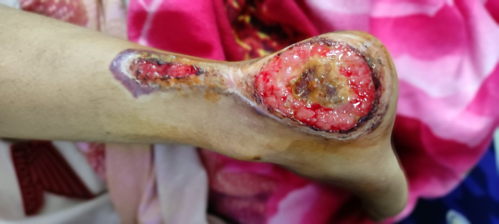 Thermal Injury during laparoscopic surgery