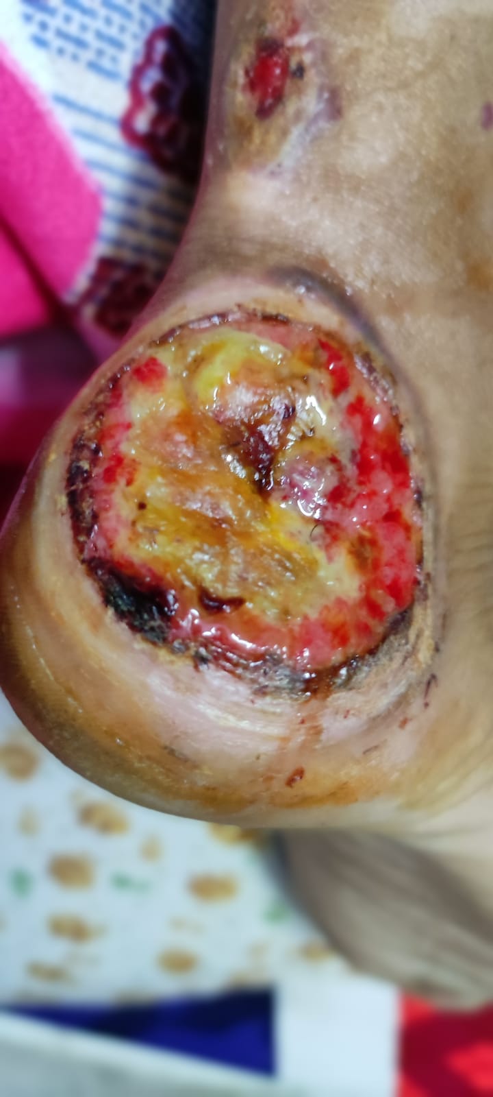 Electrical Burn Injury due to wrong patient plate placement.