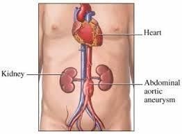 Abdominal Aortic Aneurism