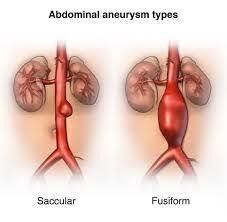 Types of Aortic Aneurism