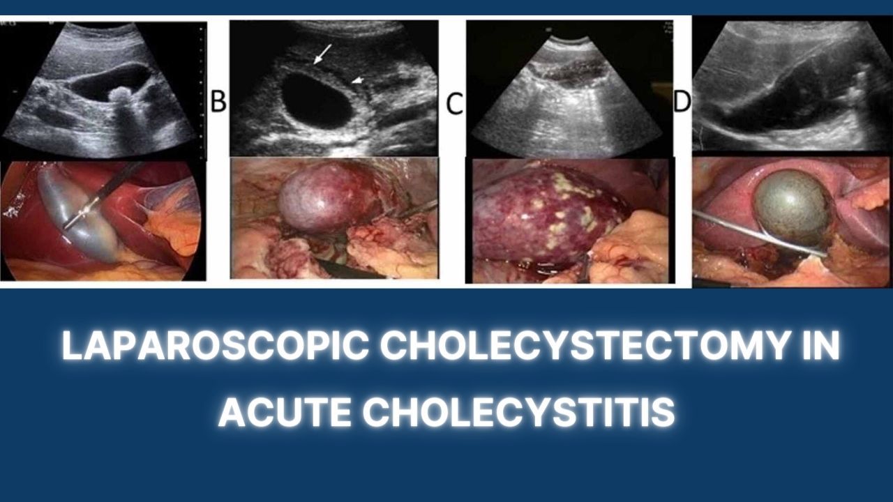 Laparoscopic Cholecystectomy in Acute Cholecystitis