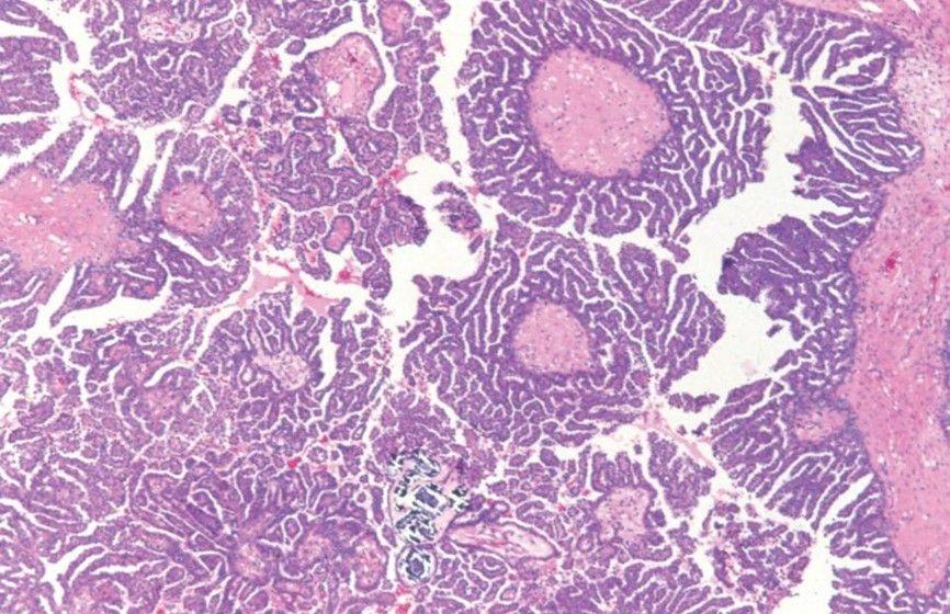 SEROUS BORDERLINE TUMOR WITH MICROPAPILLARY PATTERN