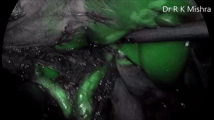 Indocyanine green (ICG) enhanced fluorescence in laparoscopic surgery