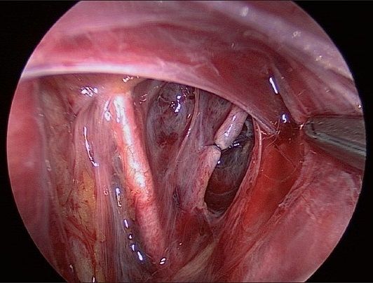 Ligation of Uterine Artery