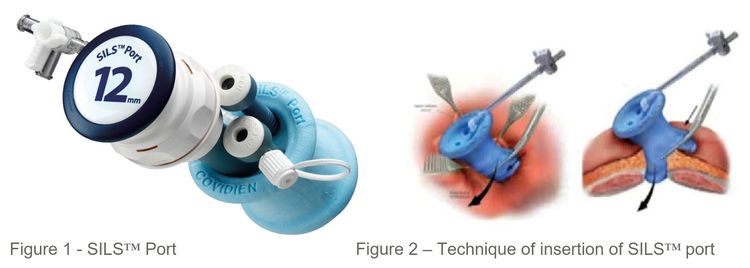 Single Incision Laparoscopic Surgery