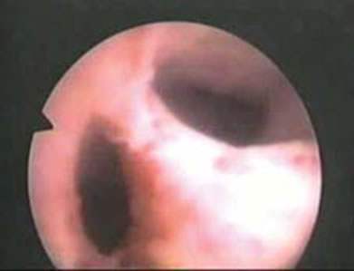 Septate