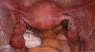 Da Vinci Robotic laparoscópico y la histerectomía ha aumentado considerablemente en número durante la última década