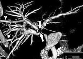 Trisectionectomía derecha totalmente laparoscópica mediante abordaje glissoniano intrahepático